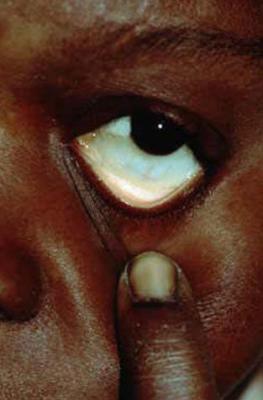 Symptoms of anaemia